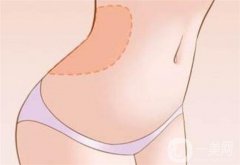 吸脂會(huì)不會(huì)出現(xiàn)反彈？吸脂后應(yīng)該注意什么呢？