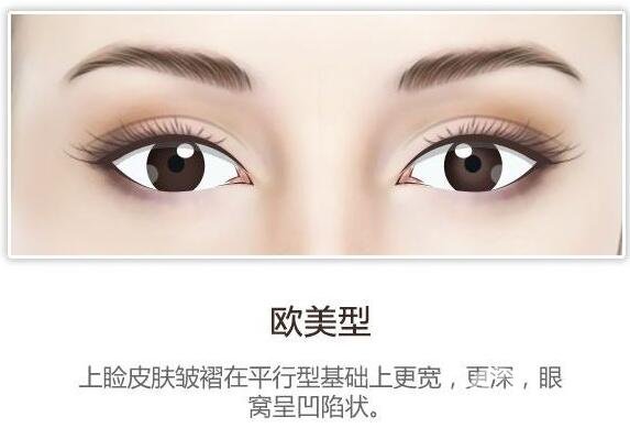 開眼角后疤痕增生怎么辦？