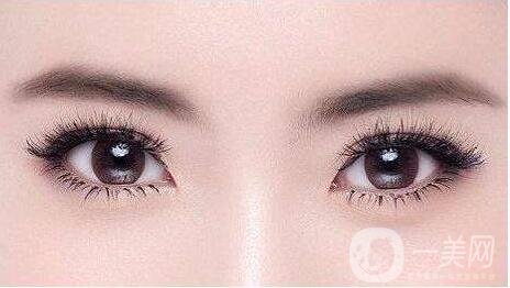 烏魯木齊軍區(qū)總醫(yī)院割雙眼皮價(jià)格表及案例分享