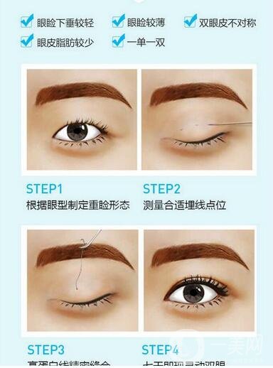 超聲波祛眼袋*嗎 祛眼袋前后照片