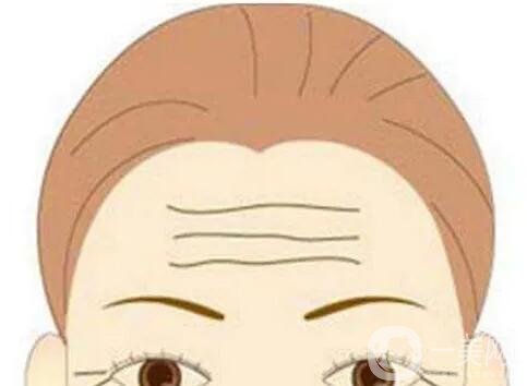 去掉抬頭紋要多少錢？