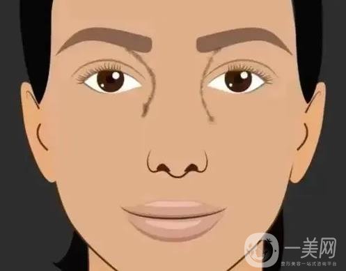 廣東玻尿酸豐眉弓手術(shù)費(fèi)用,玻尿酸豐眉弓副作用