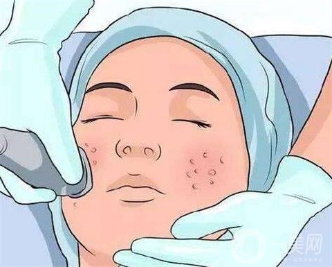 激光祛痘注意事項(xiàng)有哪些？