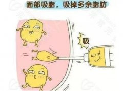 成都面部吸脂多少錢?價格影響因素大盤點(diǎn)