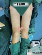 自從在醫(yī)院做了大腿吸脂手術(shù)以后，我終于擁有了兩條纖細(xì)筆直的漫畫腿