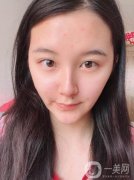 在整個(gè)過(guò)程中不會(huì)感覺(jué)到什么疼痛，現(xiàn)在熱瑪吉已經(jīng)發(fā)展到第五代了