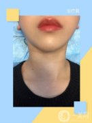 打完嗨體已經(jīng)有一周的時(shí)間了，現(xiàn)在脖子上面的紅腫已經(jīng)完全不見(jiàn)了