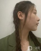 剛做完拉皮的這幾天真的是特別的不適應(yīng)，因?yàn)槊刻於加性诖黝^套