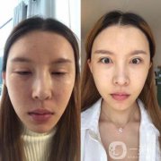 聽老朋友的話以后，我也覺得這個(gè)熱瑪吉手術(shù)挺好的，就想去試試