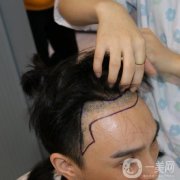 在朋友推薦之下，我終究還是做了植發(fā)手術(shù)，經(jīng)過長期以來的生長