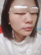 心心念念的雙眼皮終于是做完了，對自己的雙眼皮一直以來都是特別的不滿意