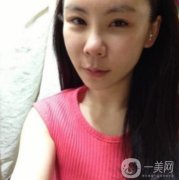 因為我自己身上的脂肪不是太多，所以醫(yī)生看到我這樣的面部直接給我推薦的是