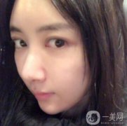 做完面部填充手術(shù)已經(jīng)半年的時間了，現(xiàn)在我的臉部脂肪已經(jīng)穩(wěn)定下來了