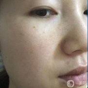 做完皮秒祛斑已經(jīng)是第15天了，做這個(gè)皮秒之前，會(huì)給你打麻藥，不用擔(dān)心疼