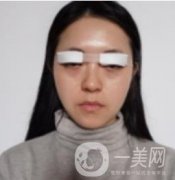 我來了，我來了，做的眼綜合，半個(gè)月才拆線 效果很好