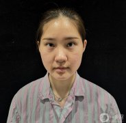 我的鼻子做了，前兩天沒敢洗臉