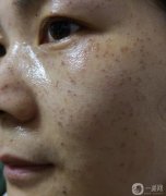 做的蜂巢皮秒祛斑，恢復(fù)期間都比較黑，看起來有點(diǎn)不好看