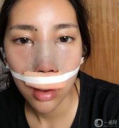 大概是隆鼻后第10天，去醫(yī)院把線取出來了