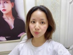 面部吸脂手術(shù)是一個純粹的微創(chuàng)手術(shù)所以在聽了醫(yī)生的建議后，我決定做面部吸