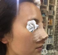 時(shí)間過得真快，做完隆鼻已經(jīng)一周了