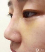 手術(shù)已經(jīng)半個(gè)月了，整體感覺還不錯(cuò)，沒有異物感