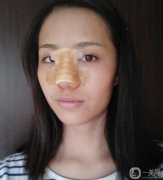 鼻子還在恢復(fù)中,還是有點(diǎn)硬，手感還沒有達(dá)到自然