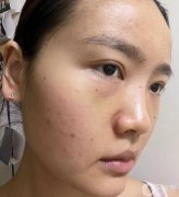 術(shù)后第四天，鼻子形狀很美