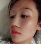 鼻部修復第7天醫(yī)生說我恢復的很好,越來越羨慕自己，不知道當初的勇氣是從哪
