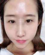 一直對自己的鼻子不滿意,雖然挺高，但是肉多