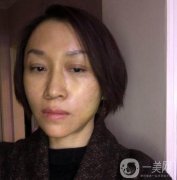 做熱瑪吉過后，臉是又白嫩又Q彈