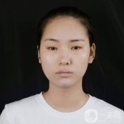 面部的小拉皮手術(shù)切口小，創(chuàng)傷小，恢復(fù)快