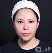 面部拉皮手術(shù)的第二天，臉上有強(qiáng)烈的緊繃感覺(jué)