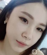 做了拉皮手術(shù)的第一天，自己的臉是真的腫