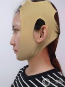 拉皮手術(shù)十六天了，恢復(fù)到現(xiàn)在已經(jīng)沒(méi)有那么的腫了