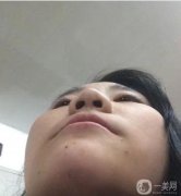 隆鼻術(shù)后兩個(gè)月，鼻子的高度剛剛好