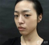 隆鼻術(shù)后一個(gè)月，鼻子大小弧度都還行