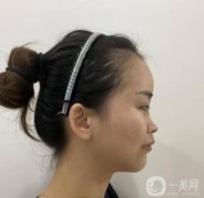 隆鼻時(shí)，美容效果可以更自然