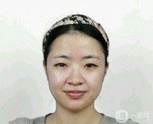 面部脂肪填充后半個月，臉就飽滿了