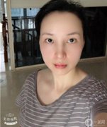 我以前做過鼻子整形，但我不滿意