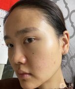 做完鼻子后，感覺效果出來了，鼻翼小很多