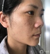皮秒祛斑手術之前和手術過程中我都是一種遺傳性的雀斑