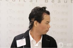 植發(fā)第一天，今天來醫(yī)院拆紗布