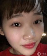 帶著一雙傷心的眼淚，鼻子手術終于結束了