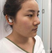 經(jīng)過一番思考，我終于決定做鼻子整形手術(shù)