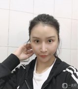 減脂很難，也瘦不了多少，所以面部吸脂真的幫了我很多