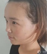 真的沒想到用脂肪填臉的效果這么好