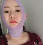 我在下部做了吸臉和線雕，解決了臉上脂肪厚度和皮脂下垂的問題