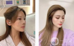 想了很久，攢了很久的錢，終于如愿在醫(yī)院做了個鼻子