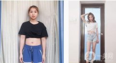 腰腹吸脂術(shù)后一個月，經(jīng)過一個月的修復，越來越漂亮，身體也越來越苗條