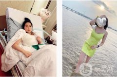 假體隆胸后15天，無不適，活動基本正常，傷口恢復相當好